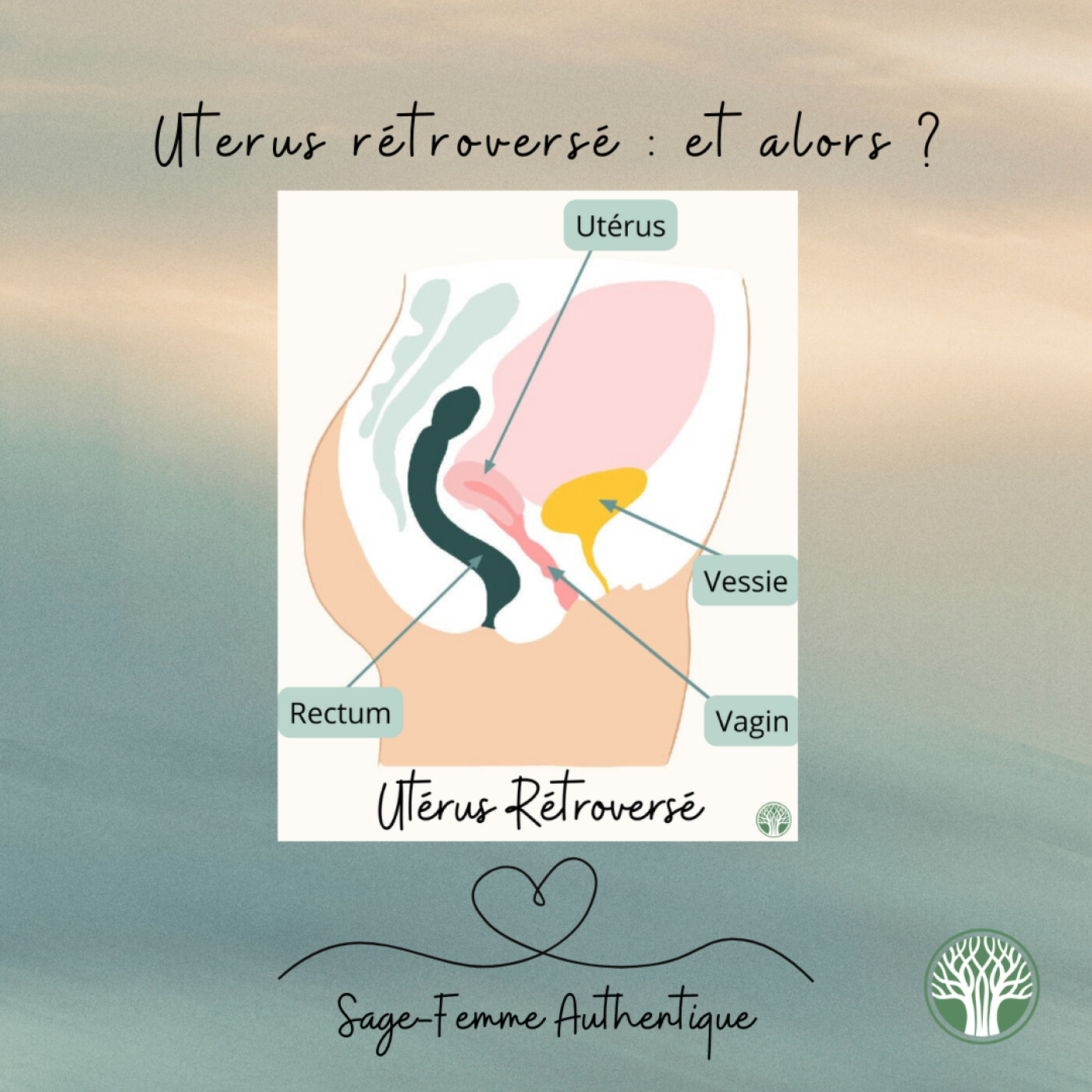Uterus rétroversé : et alors ? QSF46