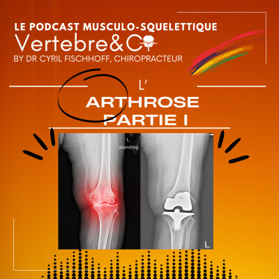 Tout sur l'Arthrose ! (Partie I) cover