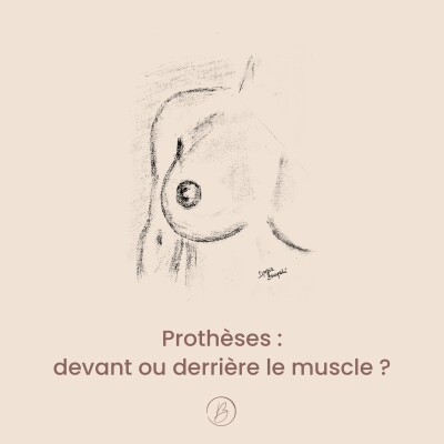 Prothèses : devant ou derrière le muscle ? La vérité sur… cover