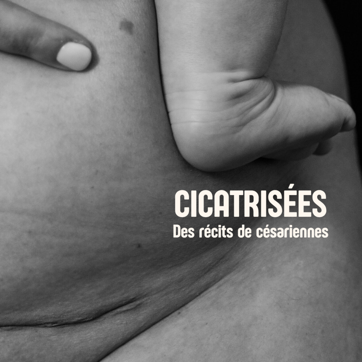 Claire, césarisée il y a 5 ans : "Je n'ai jamais regardé la cicatrice de ma césarienne" episode artwork