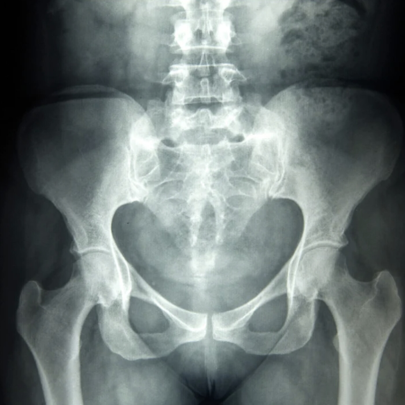 #3 - Kiné Pratico-Pratique : Fractures De Fatigue & Triathlon, Le Guide Ultime #3 - Kiné Pratico-Pratique : Fractures De Fatigue & Triathlon, Le Guide Ultime