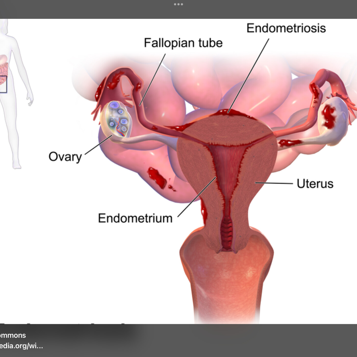Endometriosis — A Fresh Look for Everyone