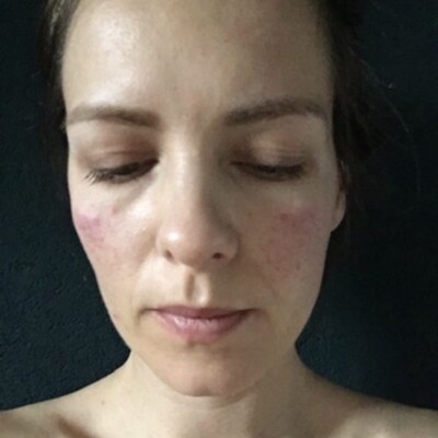 Ep.4 Solo: Ma rosacée cover