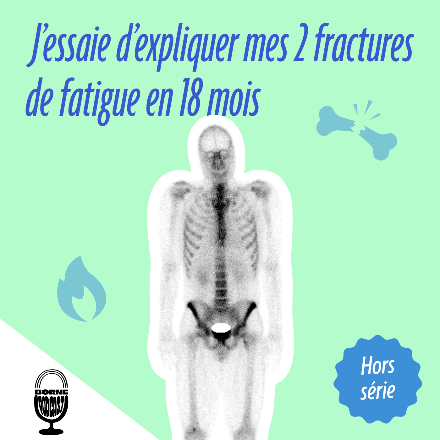 J'essaie d'expliquer mes 2 fractures de fatigue en 18 mois